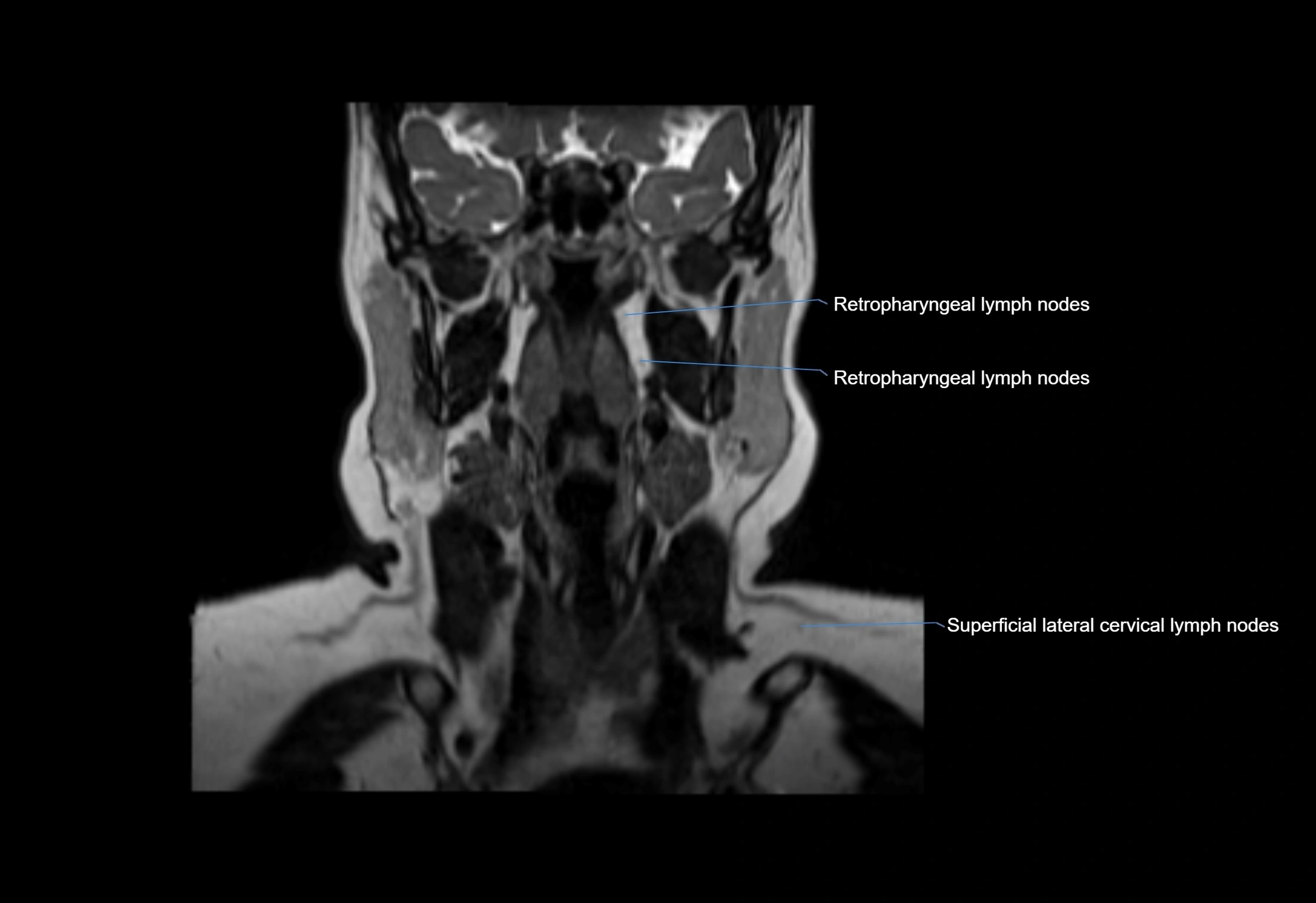 Neck coronal lymph node cross sectional MRI anatomy 3T MRI  image-img-00001-00044.webp